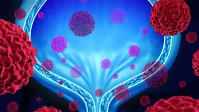 ما هي العلامات المبكرة لمرض سرطان المثانة؟