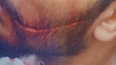 مأساة جديدة في مستشفى السيد جلال.. اعتداء بمشرط على طبيب امتياز داخل الطوارئ