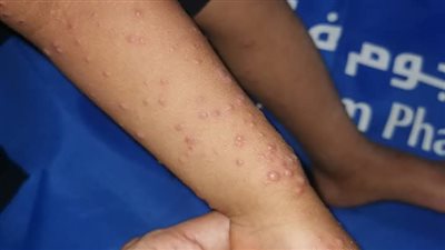 بعد رصد إصابات بالمدارس.. كل ما تحتاج معرفته عن مرض اليد والقدم والفم(HFMD)