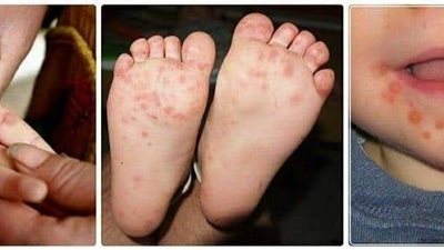 وزارتي الصحة والتعليم تطمئنان أولياء الأمور: مرض اليد والقدم والفم ليس خطيرًا ولا يستدعي إغلاق المدارس