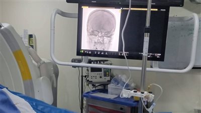 نجاح قسطرة مخية دقيقة لإنقاذ مريضة تعاني من نزيف بالمخ بمستشفى ميت غمر المركزي