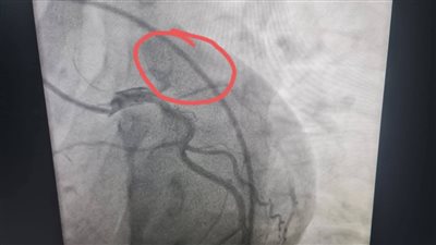  حالة طبية نادرة.. فريق بمستشفى طهطا ينقذ شابًا من جلطة بالشريان التاجي