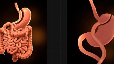 ما الفرق بين عملية الساسي وتحويل المسار ؟ دكتور أحمد المصري استشاري جراحات السمنة في مصر