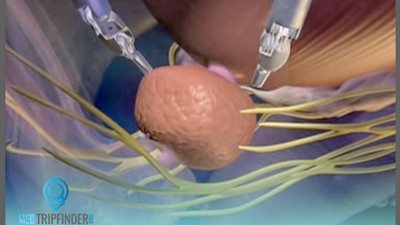 افضل طرق لاستئصال البروستاتا في مركز MedTripFinder