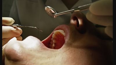 العلماء يكتشفون صلة مفاجئة بين صحة الأسنان والسكتة الدماغية