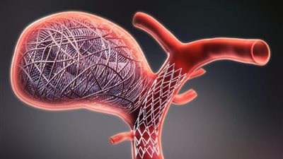 ما هو تمدد الأوعية الدموية الدماغية؟ وما أسبابه؟