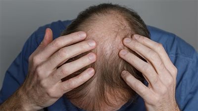 خبراء يكشفون عن طريقة علمية لعلاج تساقط الشعر