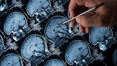 علاج بسيط من داخل الجسم مفتاح الحماية من الزهايمر