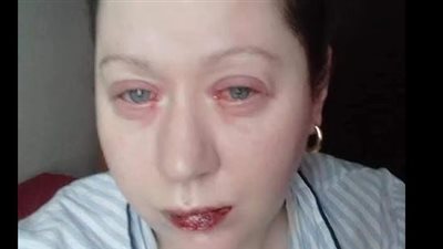 ما هي متلازمة ستيفنز جونسون التي تجعل العيون تبكي دمًا؟