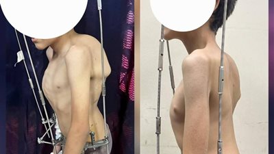 بعد تعقيد بالغ.. نجاح جراحة استثنائية لطفل مصاب بتشوه نادر في العمود الفقري..صور