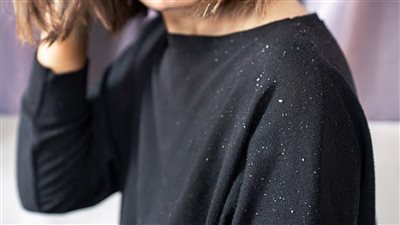 دراسة صادمة: نصف سكان العالم مصابون بمشكلة قشرة الرأس