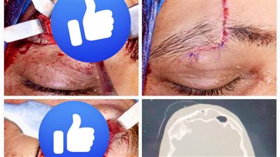 نجاح جراحة دقيقة لإنقاذ مريض من كسور متعددة بالوجه بمستشفى دكرنس بالدقهلية