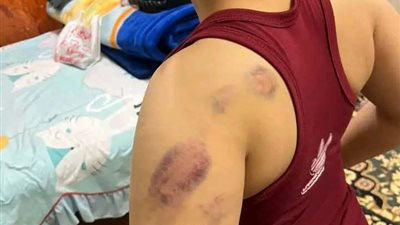 ضرب تلميذ ابتدائي يشعل الشرقية.. والتحقيقات تدين المعلمة