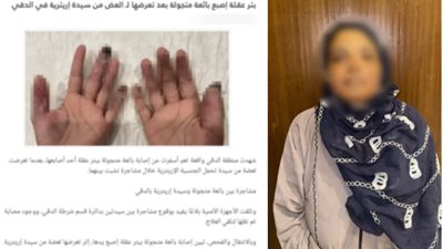 بتر إصبع بائعة متجولة بعد تعرضها للعض من سيدة إريتربة بالدقي