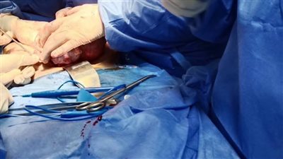 الفريق الطبي بمستشفى كفر البطيخ المركزي ينجح في جراحتين دقيقتين لاستئصال الرحم