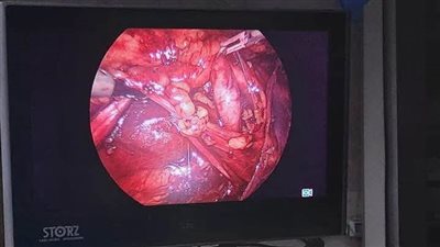 دمياط تشهد تدخلا جراحيا دقيقا لعلاج حالة الحالب خلف الوريد الأجوف