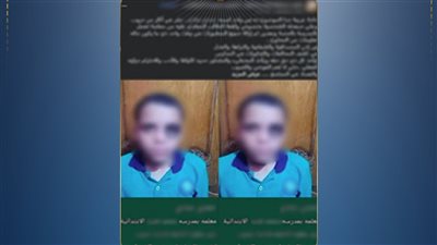 بعد انتشار صور إصابته.. طفل الإسماعيلية يعترف: «ادعيت على المعلمة خوفًا من أمي»