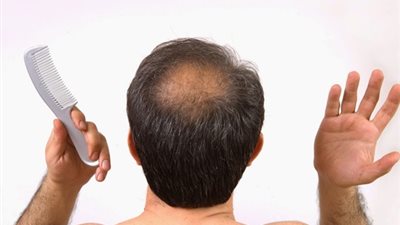 الصلع عند الرجال وكيفية الوقاية منه