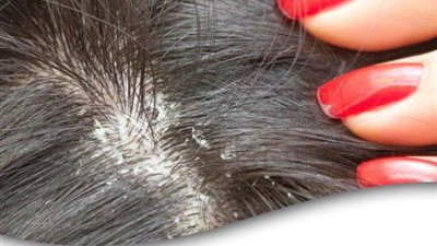 انتبه.. قشرة الشعر تنذرك بـ «أمراض خطيرة» !